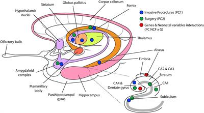 Hippocampus, Amygdala, and Thalamus Volumes in Very Preterm Children at 8 Years: Neonatal Pain and Genetic Variation